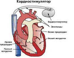 Сколько живут с кардиостимулятором. Кардиостимулятор сердца. Эхо кг с кардиостимулятором. Кардиостимулятор операция. Имплантация кардиостимулятора.