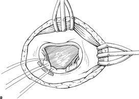 Противопоказания к операции на сердце при пороке сердца