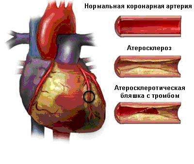 Острый коронарный синдром в беларуси