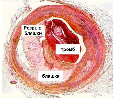 Острый коронарный синдром в рб