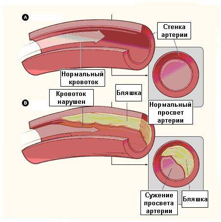 Интервенционные методы лечения ишемической болезни сердца бокерия