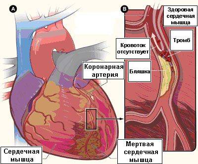 Интервенционные методы лечения ишемической болезни сердца бокерия thumbnail