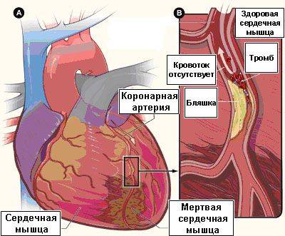 Как лечить стенокардию в домашних условиях?