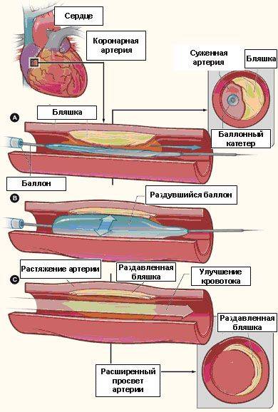 Интервенционные методы лечения ишемической болезни сердца бокерия