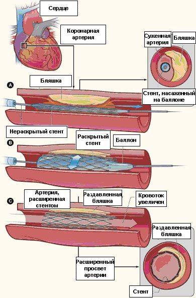 Интервенционные методы лечения ишемической болезни сердца бокерия